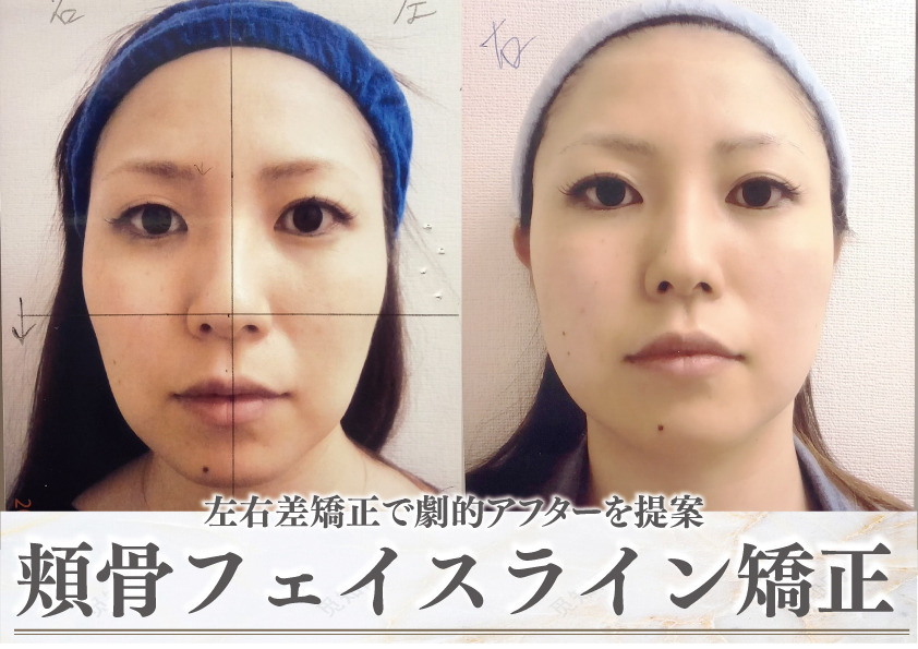  小顔矯正/左右差矯正/鎖骨・むくみ・骨盤矯正専門院　モアフェイス　池袋 の写真7枚目：