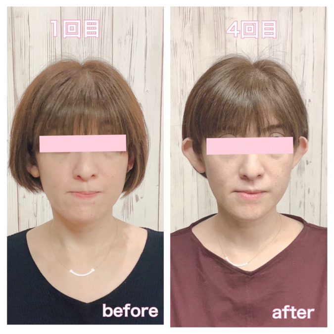 あんず美容整体サロンの写真7枚目：小顔矯正