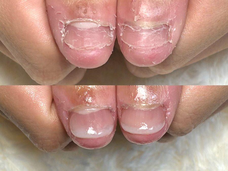 深爪矯正　爪悩み専門店　三宮店の写真