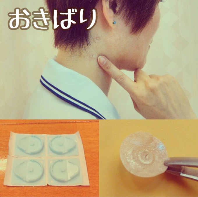 さくら鍼灸整骨院の写真14枚目：円皮鍼も行っております。