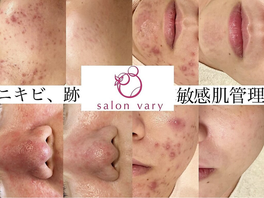 salonvary（エステティシャン/セラピストの求人）の写真3枚目：ニキビ＆敏感肌管理サロンです