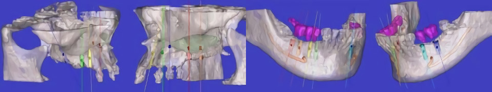 和白歯科クリニックの写真7枚目：インプラント治療には、CTのデータをもとにシミュレーションソフトを使用します。