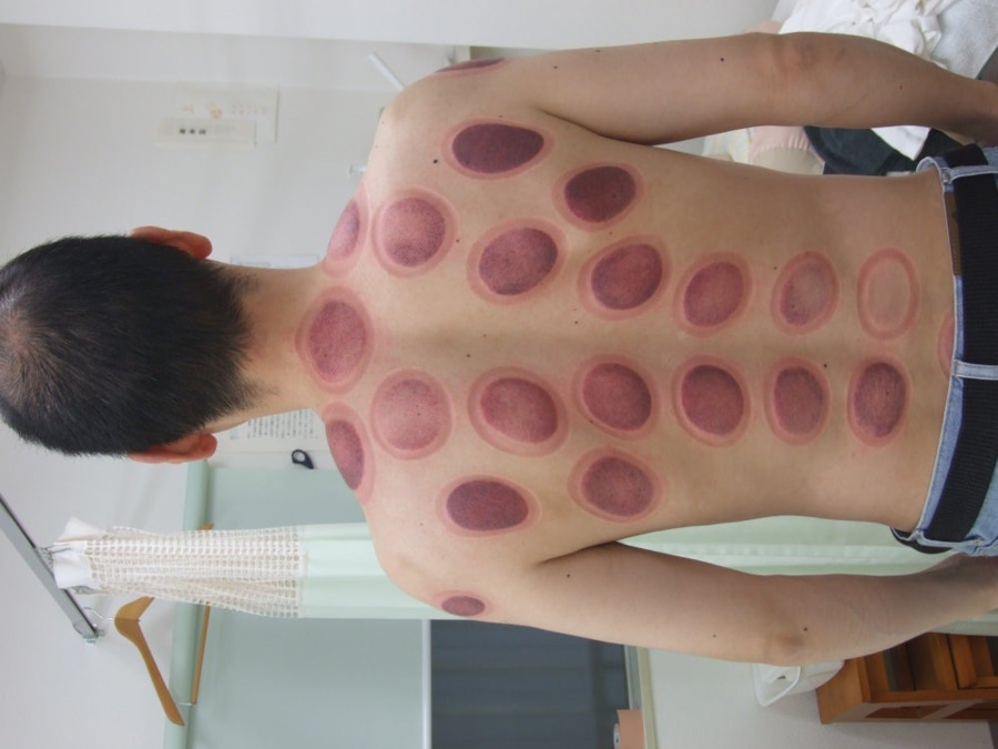 永久鍼灸整骨院（柔道整復師の求人）の写真8枚目：カッピング