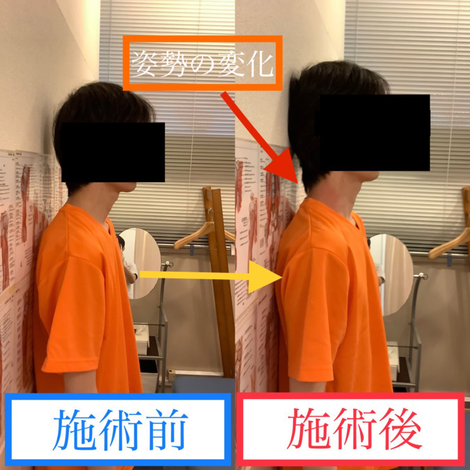 整体院ピーク銀座 （柔道整復師の求人）の写真6枚目：施術前・施術後の姿勢の変化です