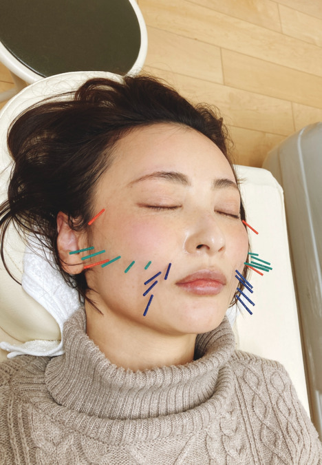 まえだ鍼灸整骨院の写真7枚目：当院の自費人気NO.1！！
プラセンタ×美容鍼です。
しっかりと美容施術も学べる