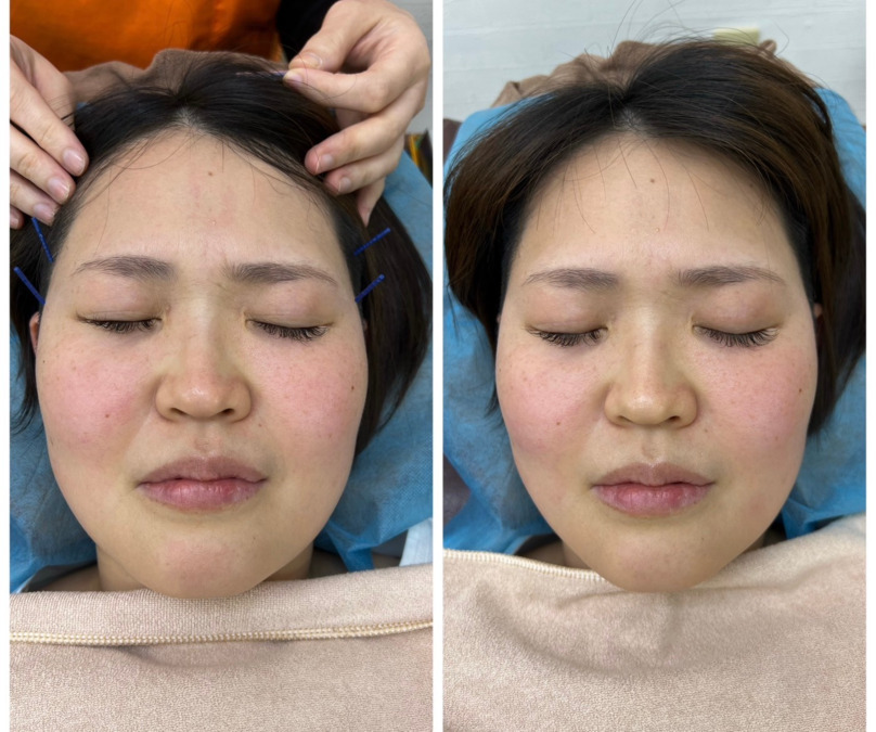 ナチュラル大山鍼灸整骨院の写真6枚目：