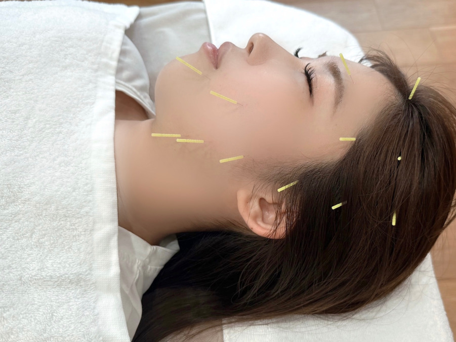 美容鍼＆INDIBA SALON Miの写真6枚目：