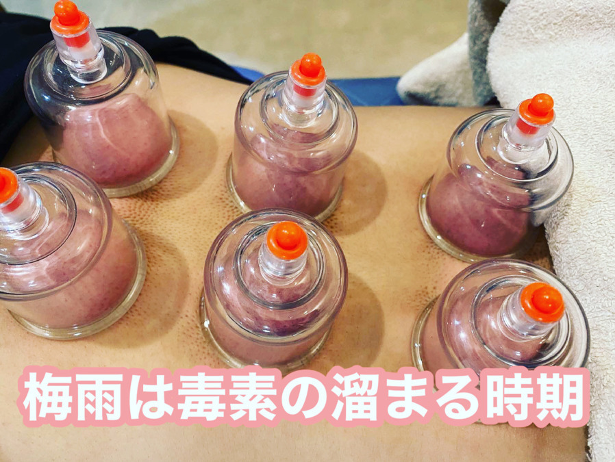 とっぷ整体整骨院（鍼灸師の求人）の写真7枚目：吸い玉治療もします！