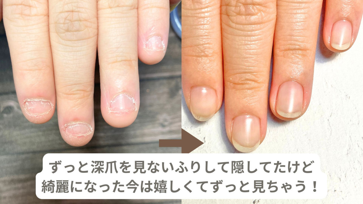 深爪矯正・自爪育成専門サロンNatuleaの写真5枚目：